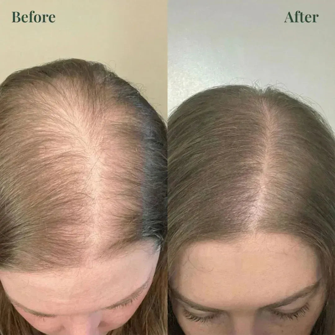 (BUY 1 GET 1 FREE) Kerarose - Magic Rosemary Hair Growth Shampoo